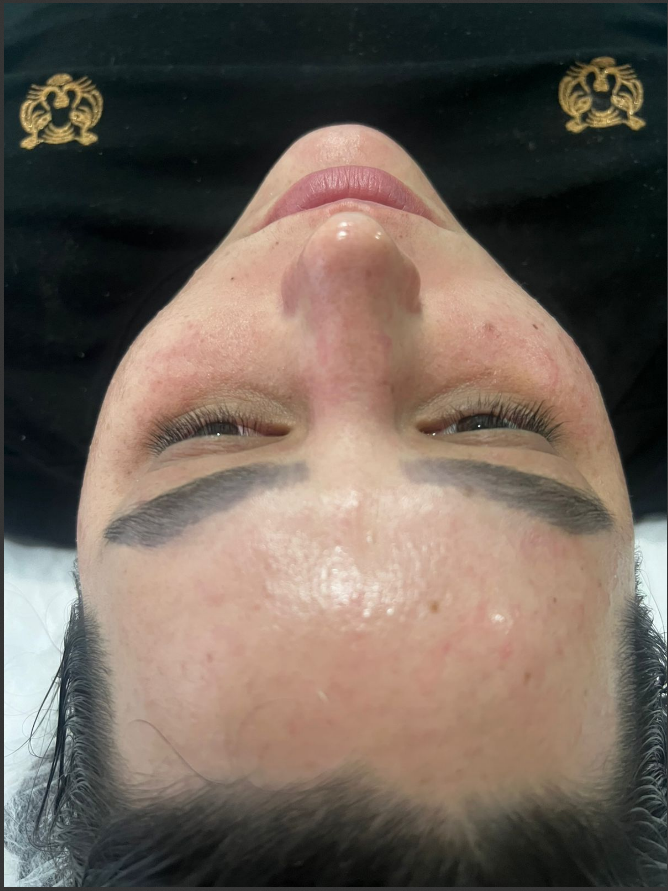 Depois do tratamento