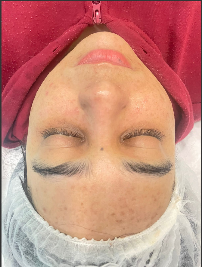 Depois do tratamento